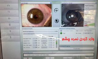 نمره چشم وارد شده به دستگاه لیزیک