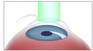شروع لیزر برای اصلاح نمره چشم توسط دستگاه لیزیک