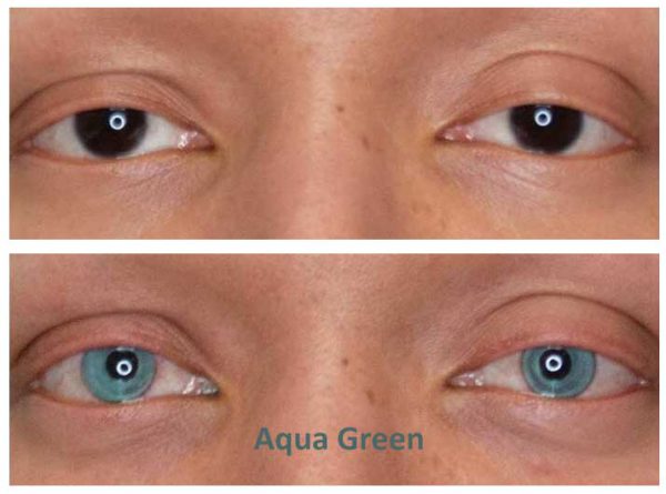 aqua green keratopigmentation