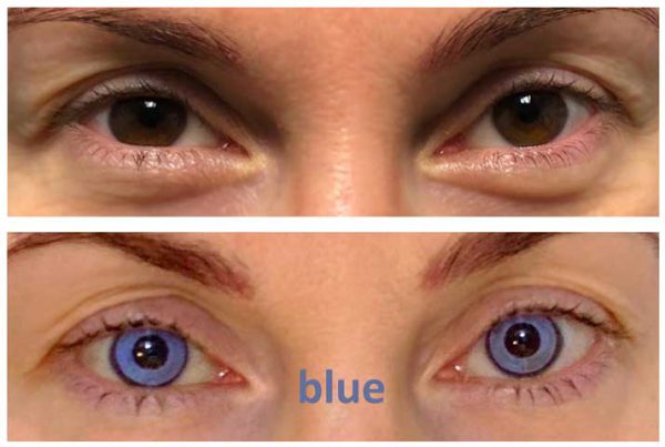 blue keratopigmentation