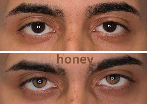 honey keratopigmentation